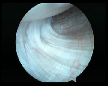 Arthroscopy Normal IGHL Humeral Attachment